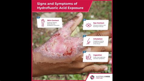 hydrofluoric acid exposure.